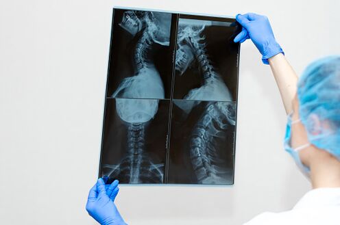 Spinal disease of osteochondrosis