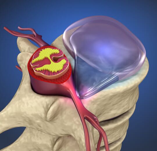 Intervertebral hernia
