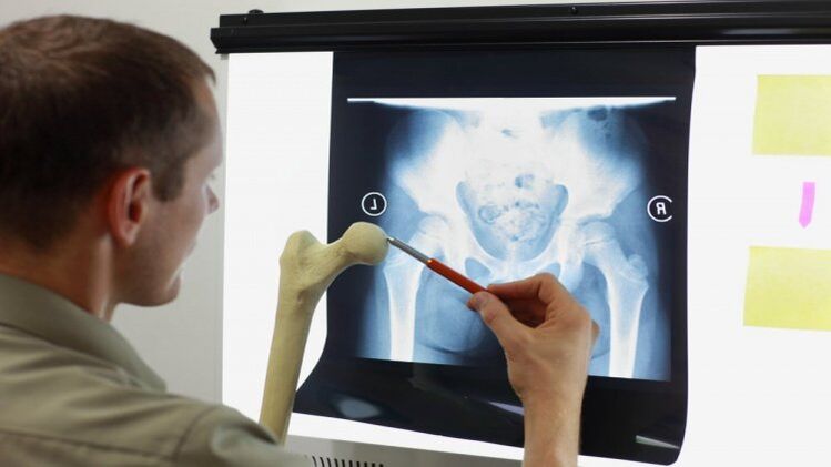 The doctor examines an X-ray for osteoarthritis of the hip joint