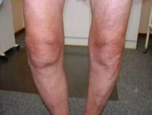 Symptoms of arthrosis of the knee joint